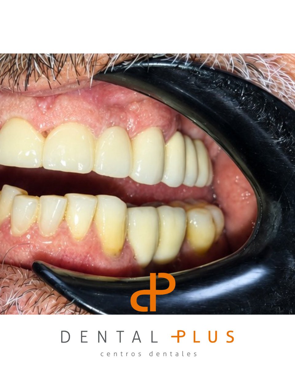 DentalplusPLUS's tweet photo. 🦷Recuperando funcionalidad, estética y confianza.
En este caso realizamos la extracción de un diente fracturado y afectado por caries, seguida de la cementación de un puente dental para rehabilitar la zona. El paciente vuelve a masticar con comodidad ✨ https://t.co/nKT0XhRopf