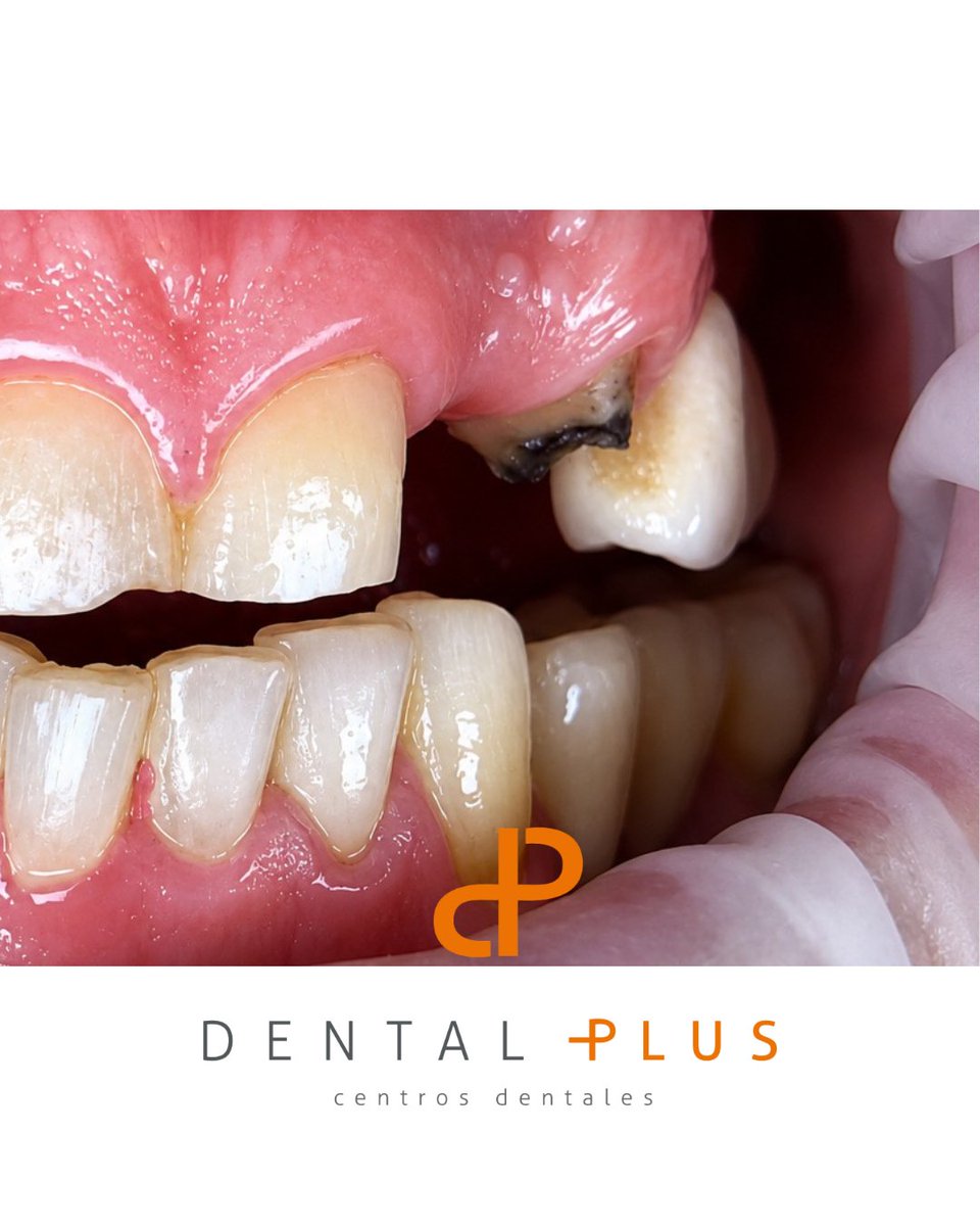DentalplusPLUS's tweet photo. 🦷Recuperando funcionalidad, estética y confianza.
En este caso realizamos la extracción de un diente fracturado y afectado por caries, seguida de la cementación de un puente dental para rehabilitar la zona. El paciente vuelve a masticar con comodidad ✨ https://t.co/nKT0XhRopf