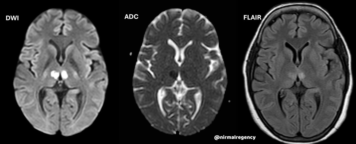 Nirmal Pandey MD DM Neurologist tweet media