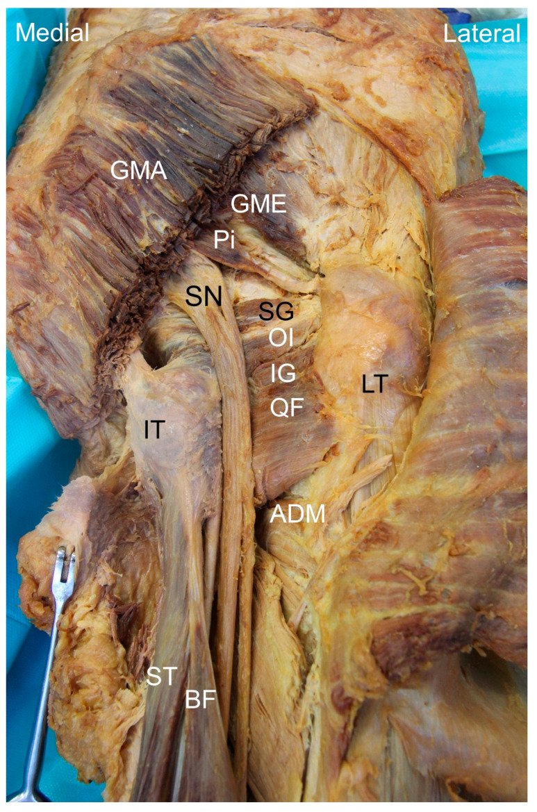 Rheumatology's tweet photo. A MUST READ
Ischiofemoral Impingement Syndrome: Clinical and Imaging/Guidance Issues with Special Focus on Ultrasonography
https://t.co/vVsmAU3AlK https://t.co/phgUnAMLOi