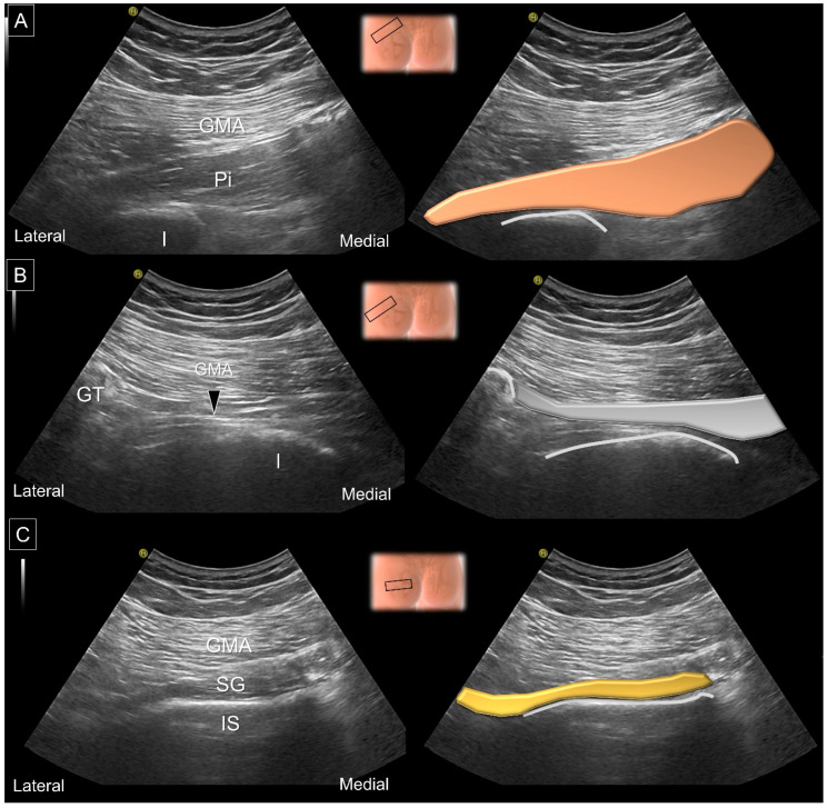 Rheumatology's tweet photo. A MUST READ
Ischiofemoral Impingement Syndrome: Clinical and Imaging/Guidance Issues with Special Focus on Ultrasonography
https://t.co/vVsmAU3AlK https://t.co/phgUnAMLOi