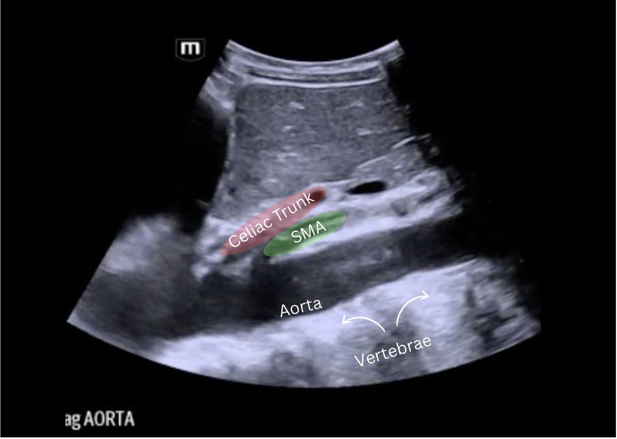 BrookdaleSono's tweet photo. Went looking for one thing... found an SMA dissection instead 👀
62 yrs old male with PMH of HTN and ESRD on HD BIBEMS today with shortness of breath.
#SMADissection #POCUS #BrookdaleSono #FOAMed #MedicalCases #EmergencyMedicine https://t.co/GAbdqY6STK