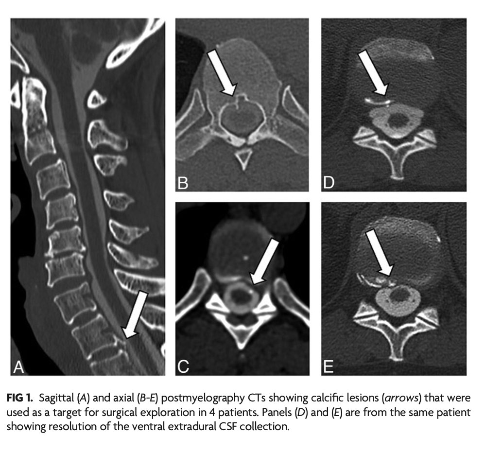 TheAJNR's tweet photo. "Surgical Exploration of Radiographically Resolved Spontaneous Ventral Spinal CSF Leaks"

https://t.co/vaoIonVWkn

@WouterSchievink https://t.co/Jx527Q5Pwk