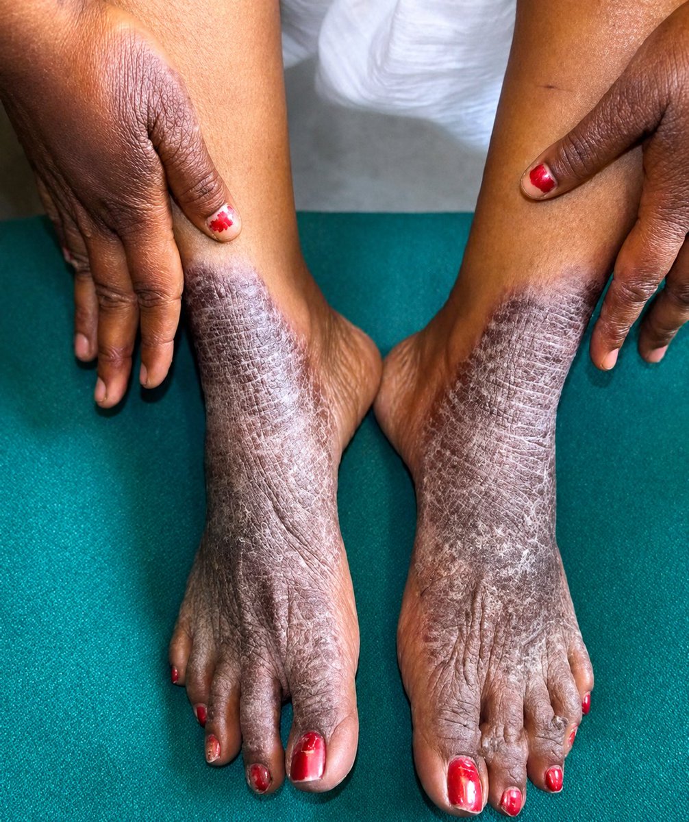 IhabFathiSulima's tweet photo. Related to hepatitis C.
What is the diagnosis? https://t.co/RghbTcs57n