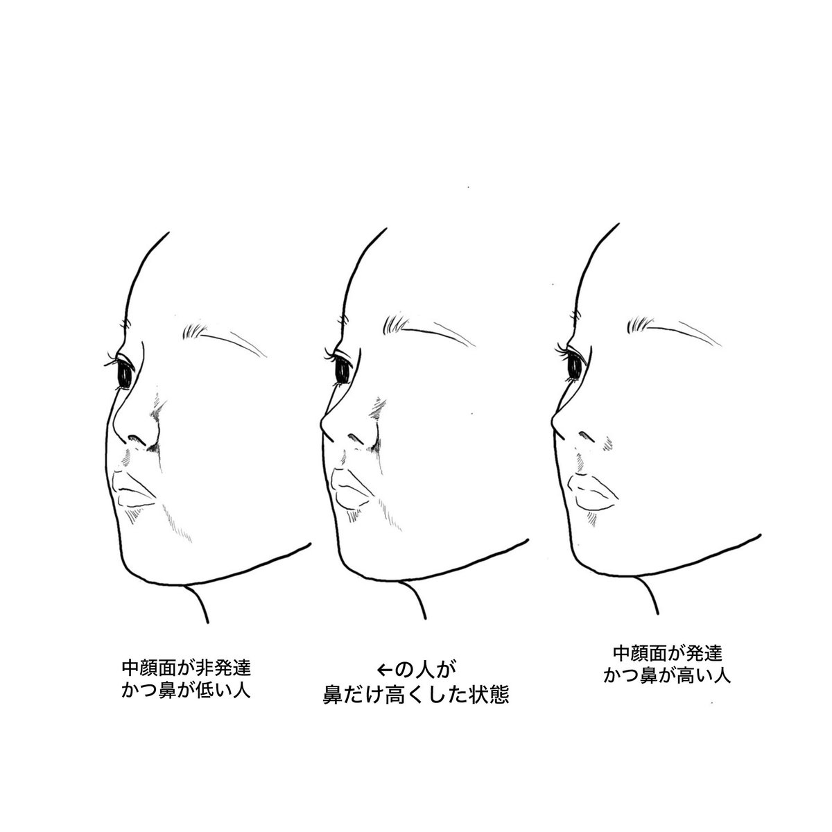 Drsaera's tweet photo. @boookk55 鼻整形は中顔面陥没はとても関係が深いです。
この図のように、中顔面が陥没しているのに鼻が高いと不自然に感じます。
中顔面が陥没していて生まれつき鼻が高い人というのは基本的にいないからです。 https://t.co/NdhpyjhOCl