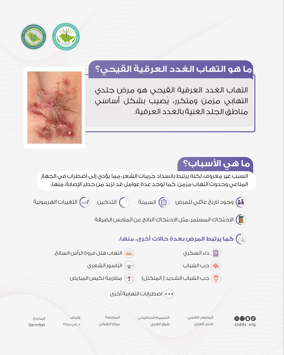 ssdds_org's tweet photo. التهاب الغدد العرقية القيحي ليس مرضًا معديًا ولا يرتبط بالنظافة الشخصية. وهو مرض جلدي التهابي مزمن يتميز بظهور عقيدات وخراجات مؤلمة ومتكررة، غالبًا في مناطق ثنيات الجلد.

خلال أسبوع التوعية بالتهاب الغدد العرقية القيحي، لنساهم في نشر الوعي ودعم المصابين. 💜
تعرّفوا على المزيد من خلال هذا الإنفوجرافيك 🔎
#ssdds_infographic