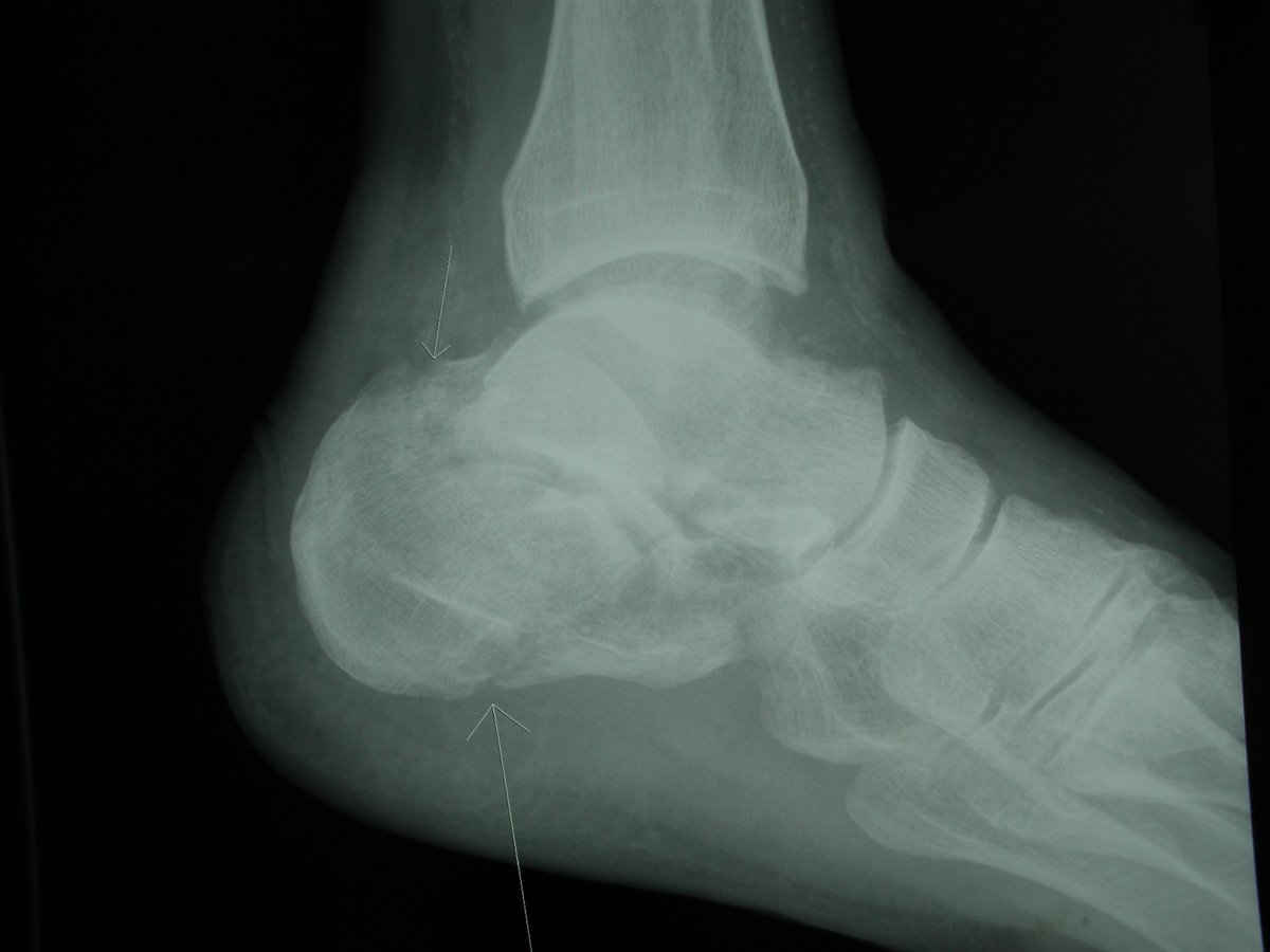 footEducation's tweet photo. A calcaneal fracture is a serious injury that can significantly impact walking and mobility.
When the fracture is displaced, surgery called ORIF (Open Reduction Internal Fixation) may be needed to restore the shape of the heel bone and stabilize it with plates and screws. https://t.co/BZNp7LGjNK