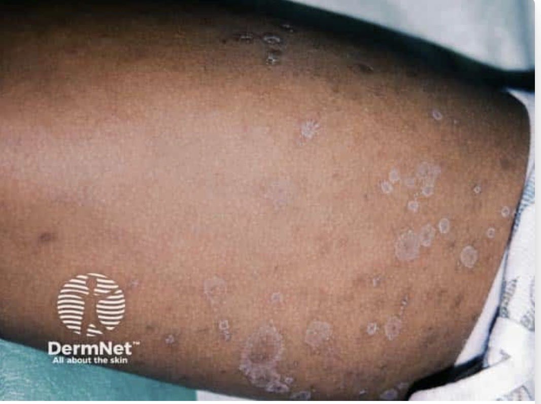 SkinofColorcomm's tweet photo. MONDAY MYSTERY!
What is the most likely diagnosis?
A.     Tinea corporis
B.     Guttate psoriasis
C.     Secondary syphilis
D.     Pityriasis rosea https://t.co/XO6eQBR7rC