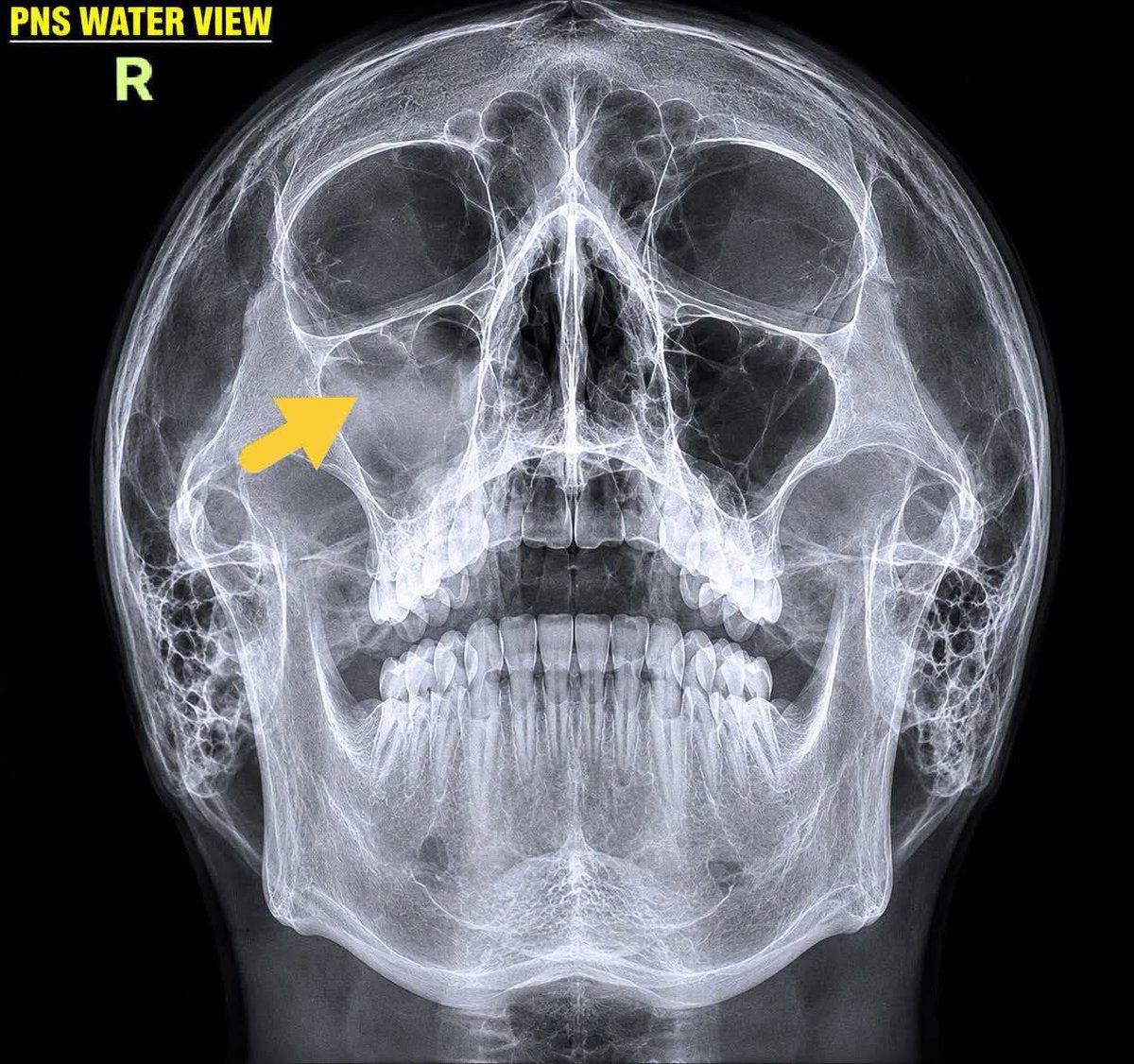 DrAyubaD's tweet photo. EASY ONE 🔥🔥
Patient with facial pain, nasal congestion and fever.
What is the lesion shown by the arrow?
What are your differential diagnosis?
#MedX #Radiology #FOAMrad #ENT #HeadNeck https://t.co/lKODlEKlJF