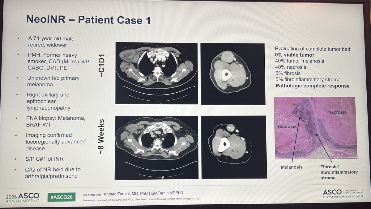 ATarhiniMDPhD's tweet photo. #ASCO26 #Chicago @ASCO | Just presented:  NeoINR Phase II study of #neoadjuvant #ipilimumab -#nivolumab -#relatlimab (INR) #immunotherapy in macroscopic resectable stage III &amp; IVA #melanoma | @MoffittNews https://t.co/tNefqg02rb
