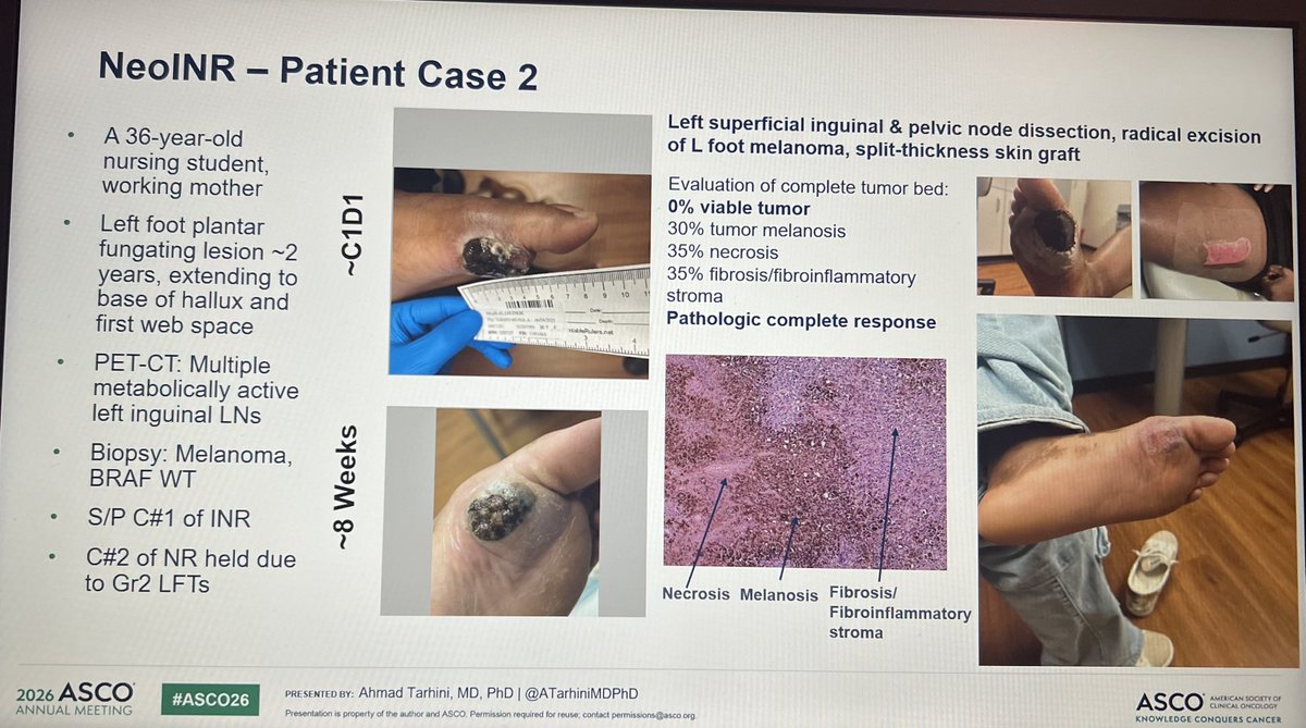 ATarhiniMDPhD's tweet photo. #ASCO26 #Chicago @ASCO | Just presented:  NeoINR Phase II study of #neoadjuvant #ipilimumab -#nivolumab -#relatlimab (INR) #immunotherapy in macroscopic resectable stage III &amp; IVA #melanoma | @MoffittNews https://t.co/tNefqg02rb