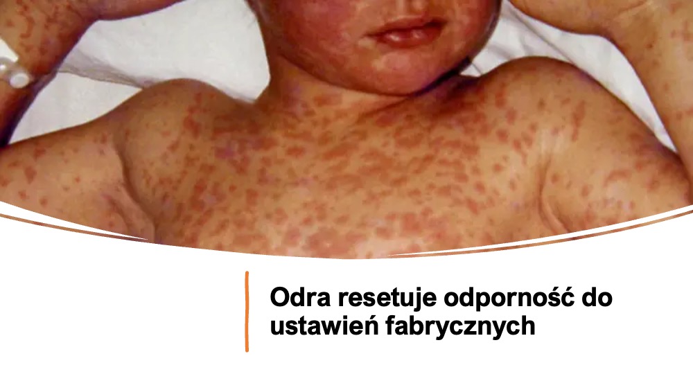 AgnieszkaSzust3's tweet photo. Long🧶Odra nie jest łagodną chorobą wieku dziecięcego. Ten wirus potrafi skasować odporność, którą budowaliście przez całe życie.
Większość z nas pamięta odrę jako gorączkę, wysypkę, kilka nieprzyjemnych dni i po sprawie. Tymczasem wirus odry robi coś, co przez lata umykało nawet https://t.co/lE6Nt7MLTH