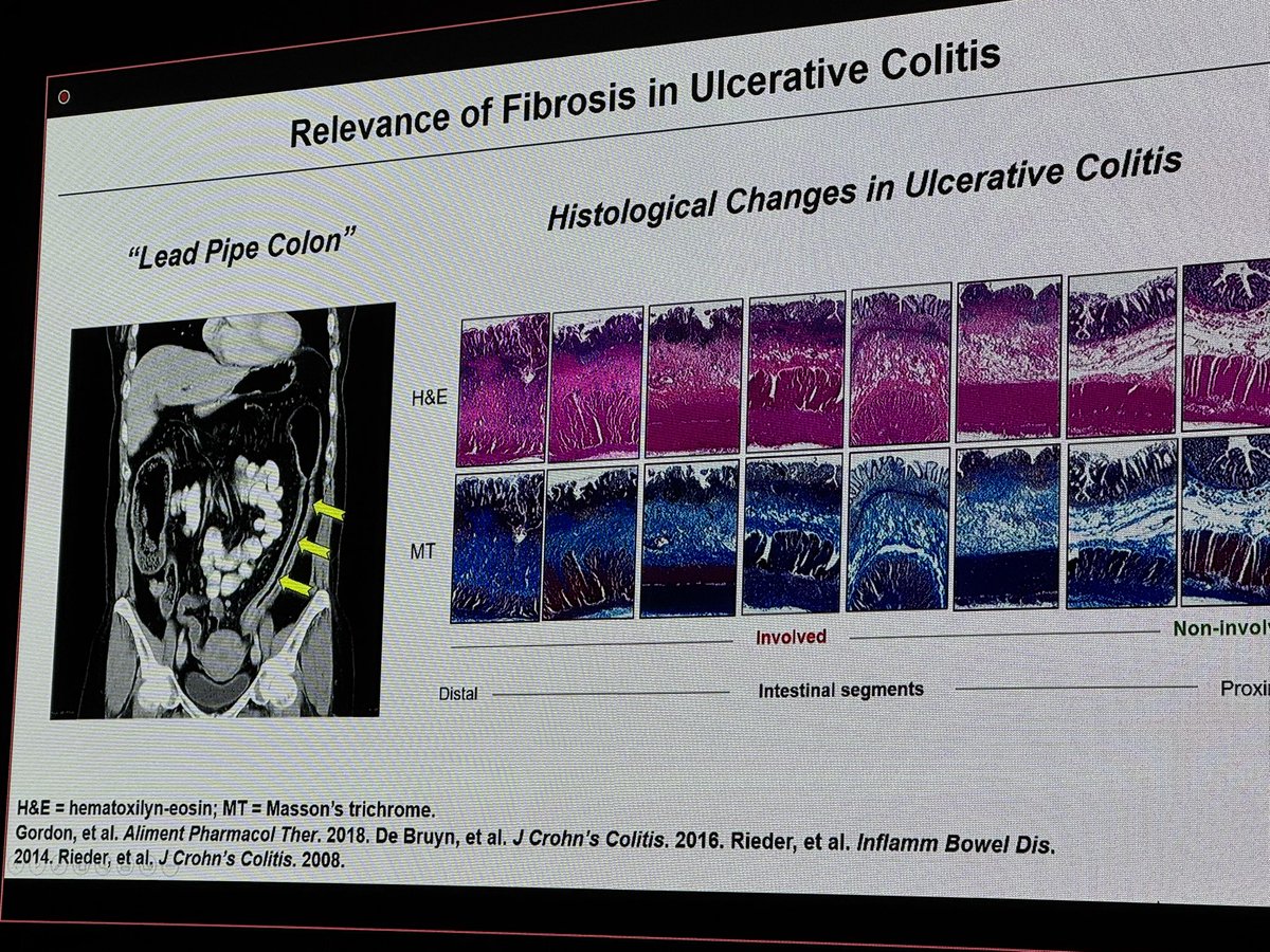 EdwardLoftus2's tweet photo. Rieder: don’t forget about fibrosis in ulcerative colitis! Mostly in submucosa not in mucosa. Transmural changes exist and fibroblasts are sending many messages @IBD_FloMD @MayoClinicGIHep https://t.co/1BRB0oxOgk