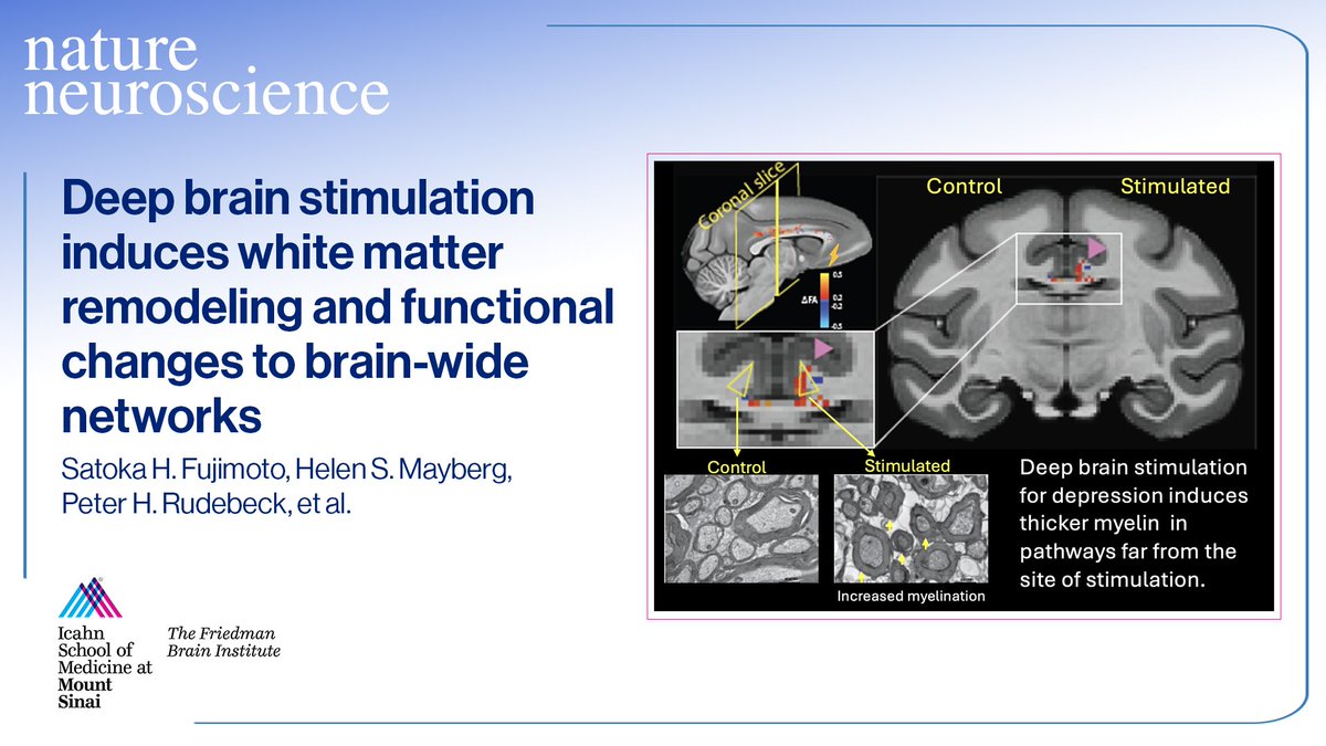 SinaiBrain's tweet photo. Landmark Study by Brian Russ, @HelenMaybergMD, Peter Rudebeck, et al. @icahnMountSinai uncovers first direct evidence #DeepBrainStimulation can remodel white matter pathways in brain &amp; alter communication across large-scale neural networks. PRESS RELEASE👉 https://t.co/TisbOnBmIP https://t.co/wNBcbzVpyg