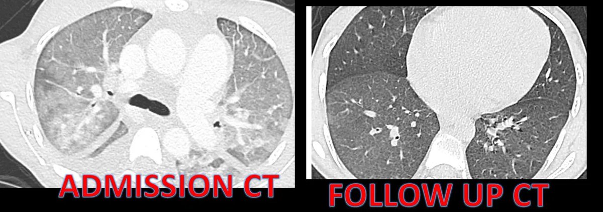sofia_gambetta's tweet photo. 🧵 Seems like chronic pulmonary edema cases are following me lately 👀
I haven't found a pathognomonic CT sign described in the literature for this entity, but after seeing a few of these, I started calling it "nutmeg lung" 🫁
Has anyone else noticed this pattern? Is there a better name for it in your practice? 🤔
#Radres  #FOAMed #RadTwitter