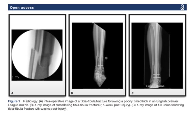TheFootballPhys's tweet photo. ⚽📊Physical preparation and return to sport of the football player with a tibia-fibula fracture: applying the 'control-chaos continuum'

🔗https://t.co/jSyOx6P7LE https://t.co/kpUvw9bjTo