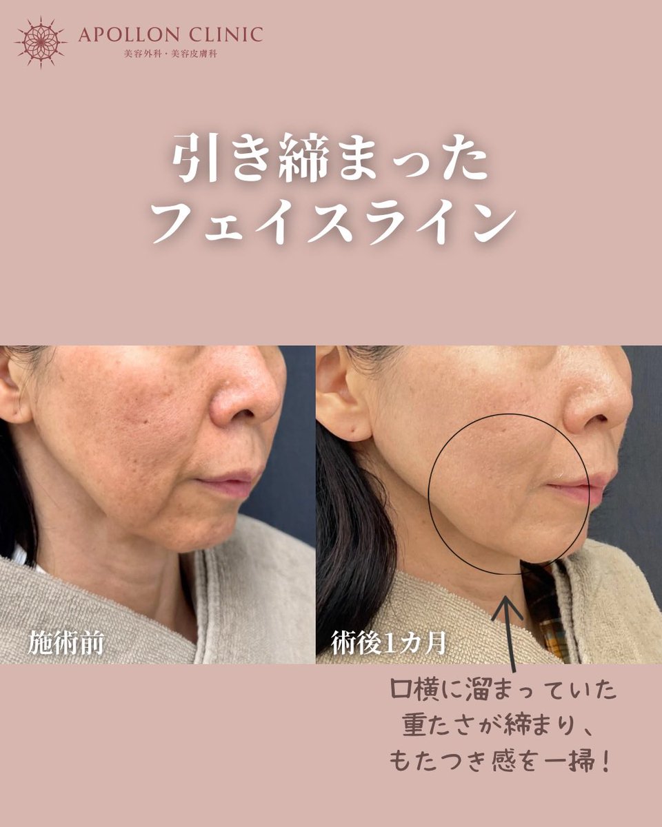 ApollonClinic's tweet photo. 50代のお手軽たるみ治療
オーダーメイドハイフ800shot
切らずに当てるだけでこんなに引き上がる❣️外科施術はちょっと…💦と思っている方にもおすすめです！ https://t.co/4MGxJJ9adv