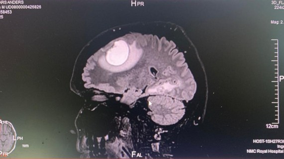 anders_ling's tweet photo. Check out my latest article: Part 2 - This picture is what made me cry, for the first time in decades. https://t.co/LcoHghECK9 via @LinkedIn 

#braincancer  #resilience #riskmanagement  #leadership https://t.co/0yHmKLOsAz