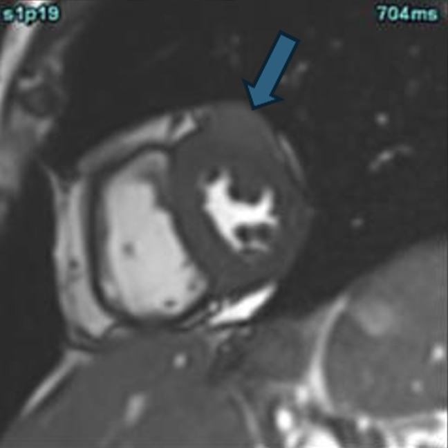 IHSCardiac's tweet photo. 🫀 What a great case! 

70-year-old woman with metastatic [withheld]. 

What’s the diagnosis? 🤔 
Check out the full blog post: https://t.co/ESiwmtaseY

#Radres #Cardiology #RadTwitter #CardiacMRI #MedEd https://t.co/eNWPTBiBbV