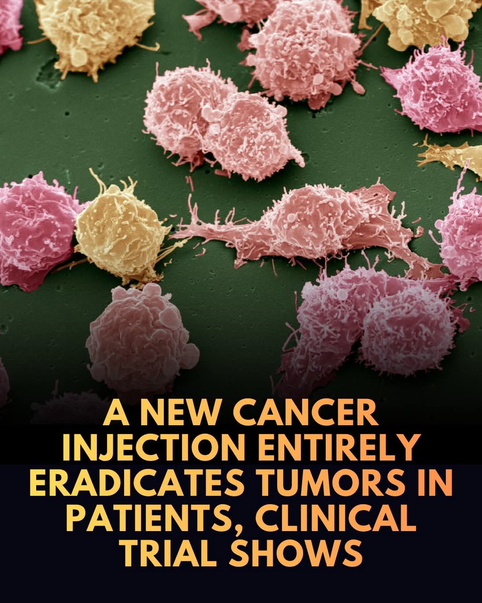 ShiningScience's tweet photo. 🎗 A new triple-action cancer jab has shown the 'unprecedented' ability to completely eradicate tumors in patients who had run out of treatment options.

The trial, presented at the American Society of Clinical Oncology (ASCO) annual meeting, evaluated 102 patients with hard-to-treat head and neck cancers that had failed to respond to chemotherapy and immunotherapy.

 Remarkably, the injection shrank tumors in over a third of these patients, and completely melted them away in 15 individuals, with dramatic improvements appearing in just weeks. 

Developed by Johnson & Johnson, the therapy works by blocking two key proteins that tumors use to grow and escape treatment, while simultaneously rallying the patient's own immune system to attack the cancer.

Beyond its extraordinary efficacy, this treatment represents a massive quality-of-life leap for patients. Unlike traditional, grueling chemotherapy regimens that require hours hooked up to intravenous drips, amivantamab is administered as a quick, convenient injection under the skin every three weeks. Patients on the trial reported minimal side effects, with many regaining their ability to eat, speak, and live pain-free lives. 

Because the drug targets cancers that are notoriously resistant to current therapies—and is currently being evaluated in 60 other clinical trials for lung, colorectal, brain, and gastric cancers—oncologists believe this smart jab could soon benefit thousands of patients worldwide, offering a powerful, elegant weapon in the fight against cancer.

source: Gregory, A. (2026). Cancer jab can eradicate entire tumours in patients, trial shows. The Guardian.