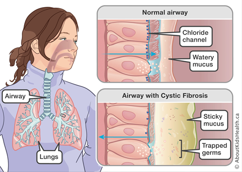 AboutKidsHealth's tweet photo. Normal mucus in the airways is thin and slippery. In people with cystic fibrosis, the mucus is sticky and clogs the airways. When the mucus gets stuck it can trap germs such as bacteria. Read more about cystic fibrosis: https://t.co/Cl5dOkfxf2 #CFAwarenessMonth #CysticFibrosis https://t.co/V5O1QRCorp