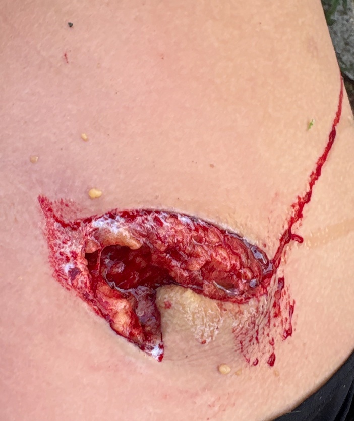 lilyyx19x's tweet photo. uhh this is from a while back and fascia #fasciatwt #twtsh https://t.co/gBUQrnxyZk