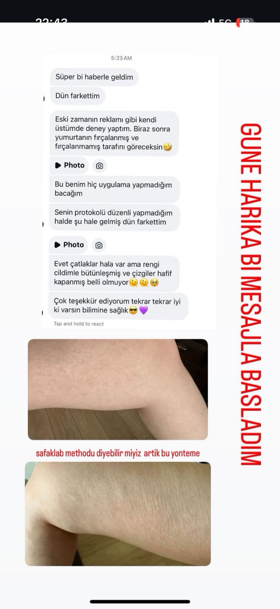 sefauygunn's tweet photo. Vücut çatlakları geçer mi diye merak ediyor olabilirsiniz evet bakır peptit + dermaroller ve centella içeren bir rutinle fazlasıyla iyi sonuçlar alabiliyorsunuz.

Instagram'da @safaklab'ı takip edin, protokolü detaylı şekilde paylaştı.

Özellikle kadınlar kesinlikle denemeli çünkü çözümsüz değil - artık bakır peptit var.
