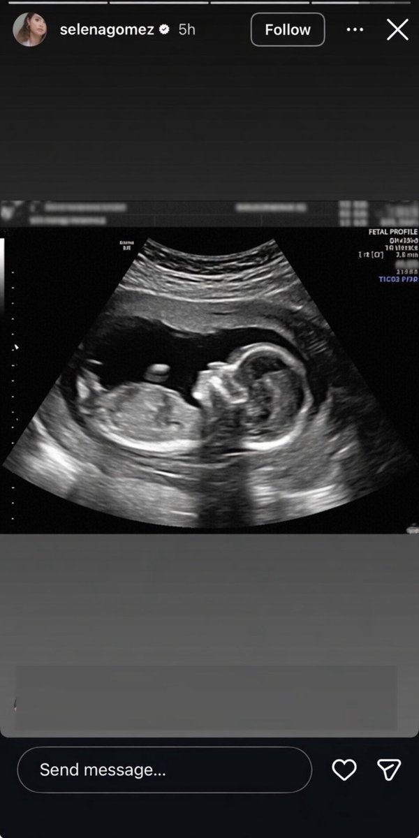 Ayo__musco's tweet photo. Selena Gomez reportedly announced on her Instagram Story that she’s pregnant with Benny Blanco’s child before deleting the post minutes later. 

If true, baby number one is already on the way! Massive congratulations to Selena after all these years. ❤️😭 And congratulations to Benny Blanco too! 👶