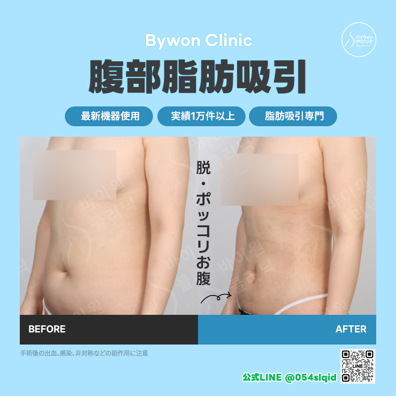 BywonClinic's tweet photo. 脂肪吸引で最も大事なのは
大容量吸引すること？

答えは… 
▶️ノー！！

むやみに吸引量を増やすと、
たるみの原因になったり、
表面が凹凸になるリスクが😰⚡

バイウォンでは
他部分との調和を考慮した
トータルデザインを徹底しています🕊🎀

ご予約・お問い合わせは公式LINEへ
💌https://t.co/WU2fCoVWJK

#韓国整形 #お腹痩せ