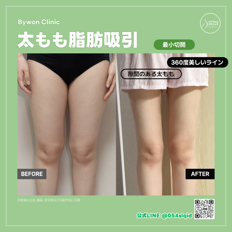 BywonClinic's tweet photo. 骨格ウェーブだから脚痩せは無理！
って最初から諦めていませんか？　　　　
　　　　
バイウォンの太もも脂肪吸引で
骨格タイプにあわせたアプローチで
憧れの美脚をかなえます😌💖

吸引した脂肪で
ヒップライン再建や脂肪豊胸も
傷跡最小＆ダウンタイム最短で❣️

不自然なガリガリ体型ではなく
健康的なメリハリボディを
めざすなら当院にお任せください🙆‍♀️

ご予約・お問い合わせは公式LINEへ🏥
💌https://t.co/WU2fCoWuzi

#韓国整形 #お腹痩せ