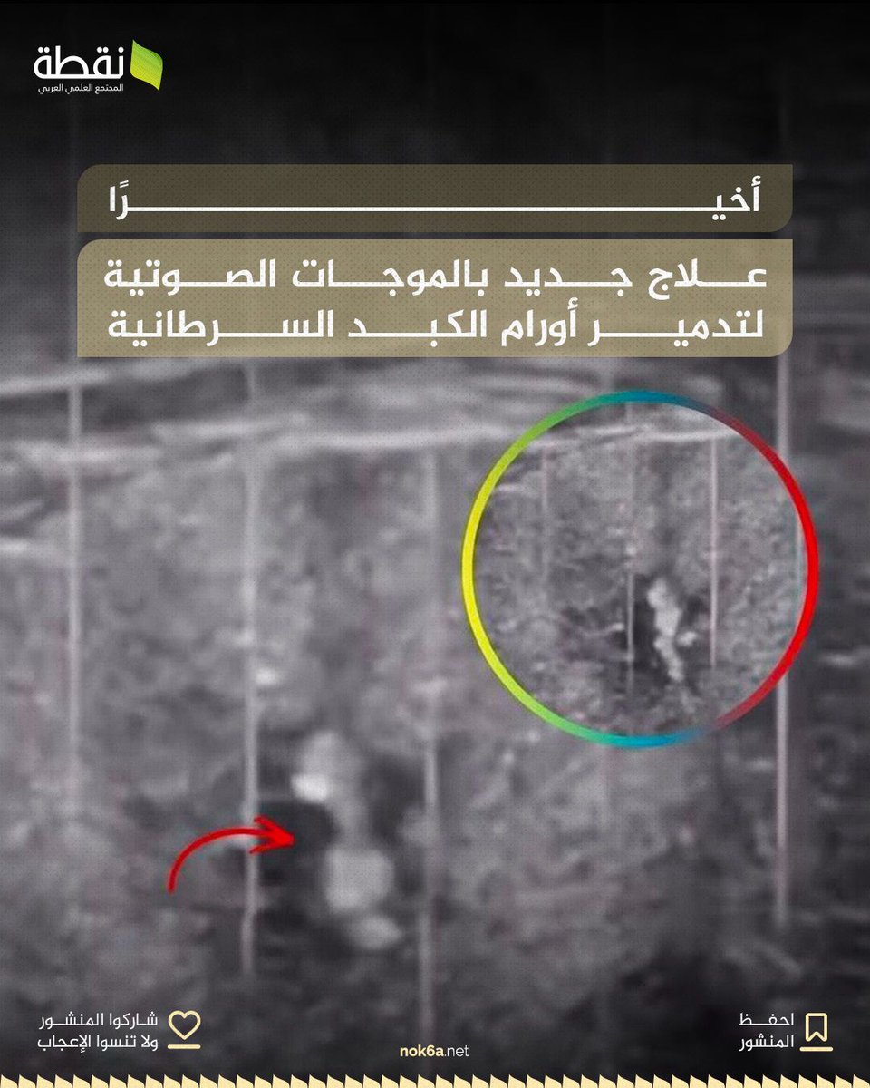 nok6a's tweet photo. تقنية جديدة تُسمى Histotripsy تستخدم الموجات الصوتية المركّزة لتدمير أورام الكبد السرطانية دون الحاجة إلى شق جراحي.

الفكرة تعتمد على توجيه موجات صوتية عالية الدقة نحو الورم، فتعمل على تفتيت الخلايا السرطانية مع تقليل الضرر على الأنسجة السليمة المحيطة. https://t.co/5VmxtVX21E