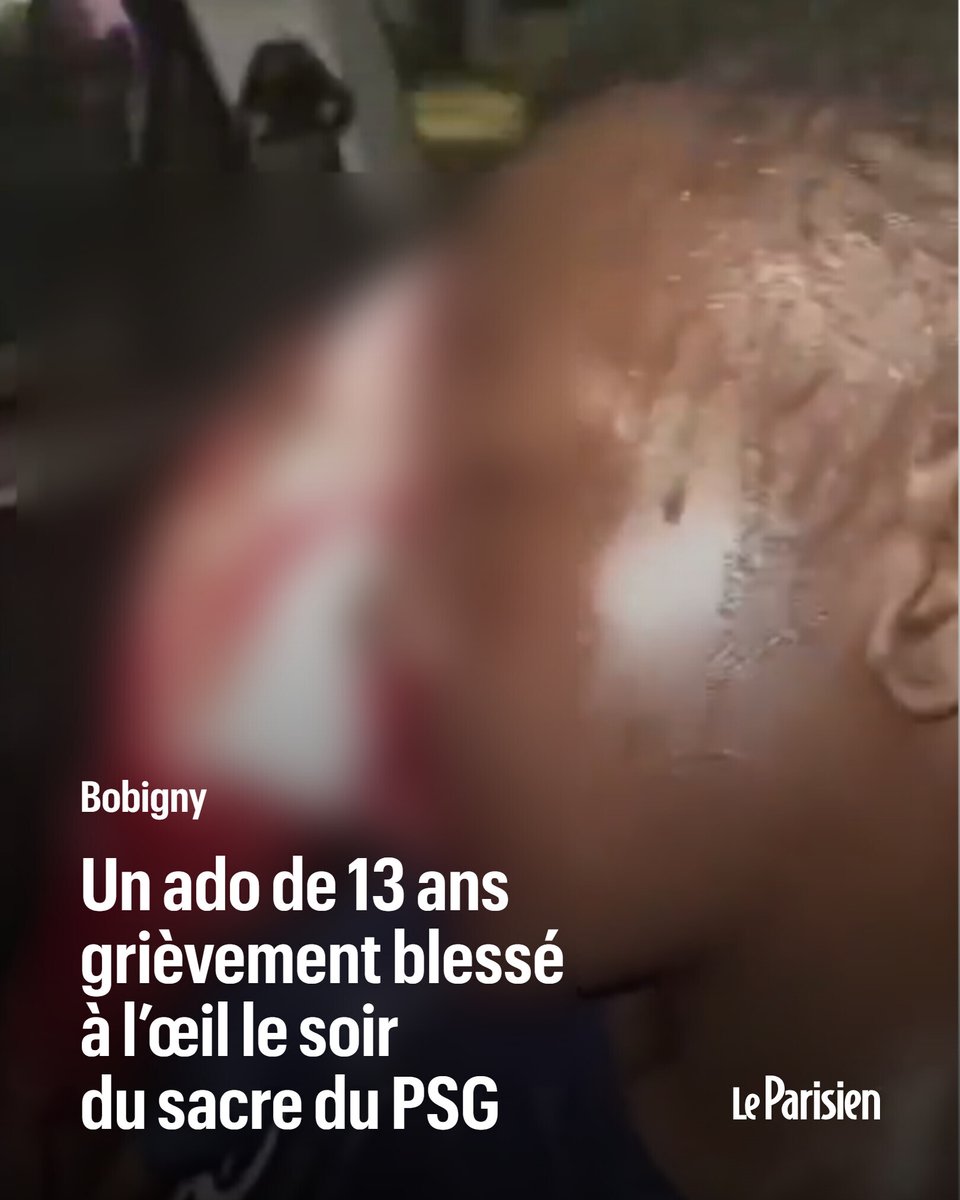 le_Parisien's tweet photo. 💬 «Imagine : tu as 13 ans. Tu célèbres la victoire du PSG. Et tu perds un œil parce qu’un policier a choisi de tirer au LBD depuis son véhicule pour disperser des jeunes dont le seul tort était de fêter un titre»

Le député élu maire à La Courneuve Aly Diouara publie une vidéo d'un adolescent gravement blessé à l'oeil et accuse la police. Le garçon de 13 ans «va perdre l'usage de son oeil», d'après l'édile.

L'IGPN a été saisie, indique le parquet ➡️ https://t.co/lC2v1bflyY