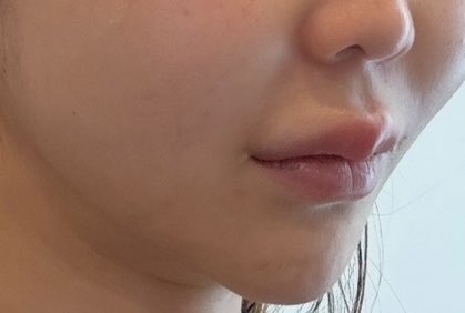 話題のソフウェーブ行ってきたよ!
口横のもたつき改善すごくない?
ウルセラとかハイフ系は脂肪も減って皮が余る感じが苦手だったんだけど、脂肪より薄い層だけに効く機械だから皮が余ってるたるみタイプに効果ありそう🌟
📍トックスエンフィル明洞店@toxnfill35jp
来院〜帰るまで爆速で良かった✨ https://t.co/Gbd685dV2R