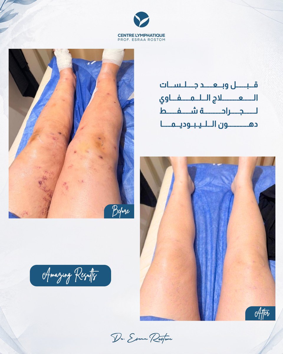 Esraarostom's tweet photo. في الصورة بنشوف الفرق قبل وبعد جلسات العلاج اللمفاوي بعد جراحة شفط دهون الليبوديما، العلاج اللمفاوي بيمون خطوة مهمة جدًا بعد الجراحة لدعم التعافي وتقليل التورم وتحسين نتائج العملية. ����

الجلسات ساعدت على تحسين تصريف السوائل وتقليل الانتفاخ ومنح الجسم مظهرًا أكثر راحة وانسيابية. https://t.co/BN56YfkwgU