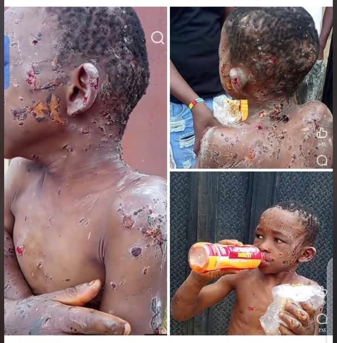 realGodwin07's tweet photo. Take your time and look at the little boy in the first and second slides. What you see all over his body are injuries inflicted on him by the heartless woman in the last slide who herself is a nursing mother (yes, a nursing mother did this to another person’s child staying with her)

Both the boy and the wicked woman are from Ukehe in Igbo Etiti local govt area of Enugu state but reside in Anambra state. The boy has since been taken to the hospital where he’s currently receiving proper medical attention. 

Indeed, “hell is empty. All the devils are here”

Before you rush here to shout women this and women that, do well to remember that this devilish woman has a husband living in that same house where all these monstrous acts on the boy were carried out. The men whose wives do these unspeakable evil to other people’s children living with them are as guilty as their perpetrator wives.
@RealCharlesOgbu 
Many African women are extremely evil and hostile toward other women’s children. Some even behave in ways that are cruel and heartless, showing a lack of compassion and empathy.
@UN @UNICEF @UNOCHA @UNHumanRights @naptipnigeria
