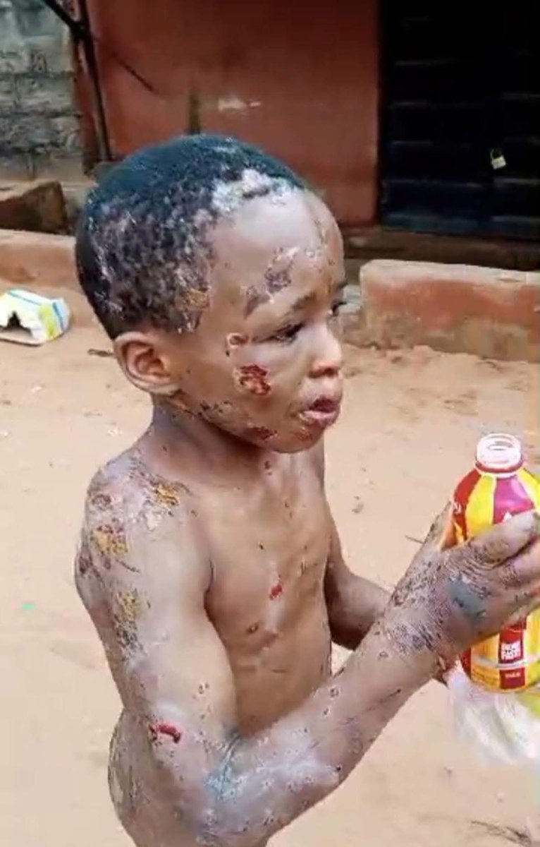 realGodwin07's tweet photo. Take your time and look at the little boy in the first and second slides. What you see all over his body are injuries inflicted on him by the heartless woman in the last slide who herself is a nursing mother (yes, a nursing mother did this to another person’s child staying with her)

Both the boy and the wicked woman are from Ukehe in Igbo Etiti local govt area of Enugu state but reside in Anambra state. The boy has since been taken to the hospital where he’s currently receiving proper medical attention. 

Indeed, “hell is empty. All the devils are here”

Before you rush here to shout women this and women that, do well to remember that this devilish woman has a husband living in that same house where all these monstrous acts on the boy were carried out. The men whose wives do these unspeakable evil to other people’s children living with them are as guilty as their perpetrator wives.
@RealCharlesOgbu 
Many African women are extremely evil and hostile toward other women’s children. Some even behave in ways that are cruel and heartless, showing a lack of compassion and empathy.
@UN @UNICEF @UNOCHA @UNHumanRights @naptipnigeria