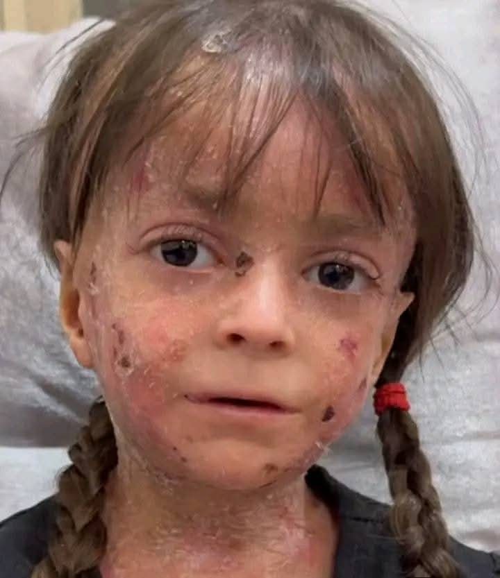 Rozana_0l's tweet photo. She suffers in silence. Ghazal is not an isolated case… but rather a face of childhood ravaged by disease in Gaza amidst the absence of treatment. https://t.co/643m1VmKni