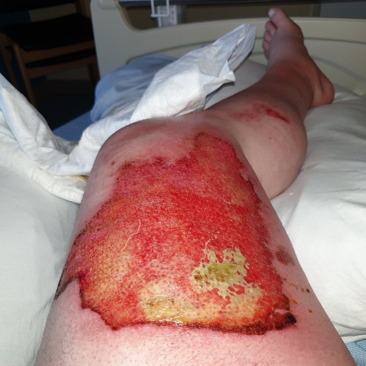 stumpyone1977's tweet photo. @RupertLowe10 This photo is my leg after a vape battery blew up in my pocket leading to skin grafts, I tried sue the shop, using solicitors Digby Brown from Glasgow, i was told I can't as vape shops are not insured, my question is, why don't they, as tbey are selling electrical devices https://t.co/Jn88YMG2Nm