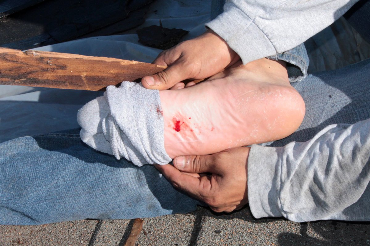 afrkml's tweet photo. #PENTING!!!
Tetanus BUKAN disebabkan oleh karat gaes, tp oleh toksin bakteri tetanus.

Bakteri ini biasanya ditemuin di tanah, debu, & lingk. outdoor

Ada TUJUH jenis luka yg berisiko tinggi tetanus:
1. Luka yang dibiarkan >6 jam tanpa penanganan medis/bedah
2. Patah tulang terbuka, terutama yg tulangnya mencuat keluar
3. Semua jenis luka tusuk yg dalam
4. Luka yg mengandung banyak serpihan/benda asing, khususnya serpihan kayu.
5. Luka rumit akibat infeksi piogenik, yaitu infeksi yg ditandai oleh peradangan lokal yg berat & biasanya ada nanahnya
6. Luka dg kerusakan jaringan yg luas, macam luka bakar/cedera remuk
7. Semua jenis luka yg terkontaminasi tanah, debu, atau kotoran hewan

Kita2 semua harus tau jenis luka risiko tinggi tetanus biar waspada & tau kudu ngapain.