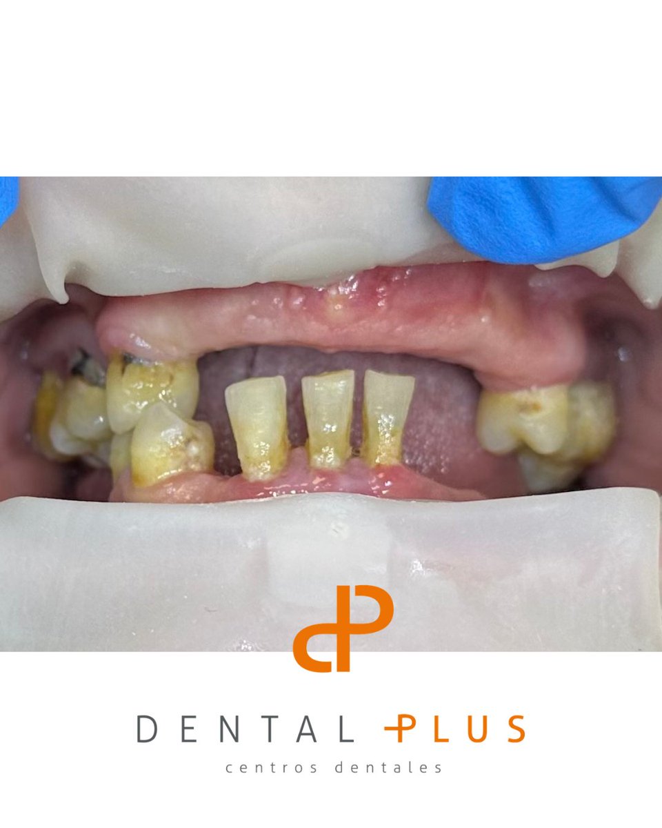 DentalplusPLUS's tweet photo. 🦷En un caso clínico de extrema necesidad, la solución se pudo realizar en un solo día.
✨La doctora llevó a cabo la extracción de todos los dientes y colocó una prótesis removible inmediata.
Un cambio radical que ha transformado la vida de la paciente🧡 https://t.co/sz0M65OzOi