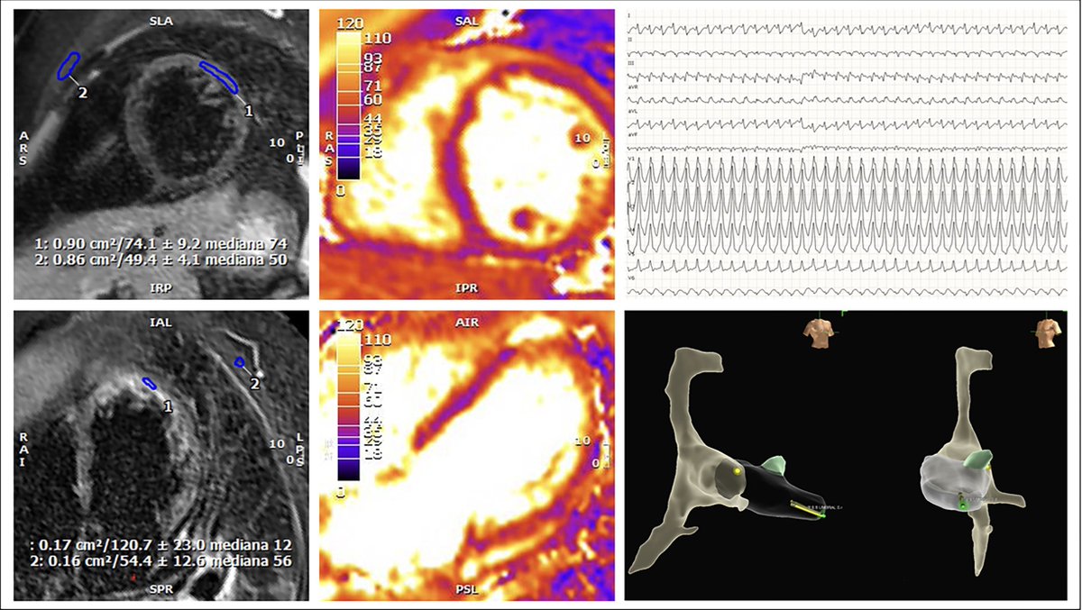 ESC_Journals's tweet photo. Management of desmoplakin cardiomyopathy manifesting as an electrical storm requires key considerations during pregnancy: using safe antiarrhythmics, avoiding gadolinium-based contrast in CMR, minimal-fluoroscopy ICD implantation, and an individualized delivery plan from a multidisciplinary team. https://t.co/6SH5rX3mzK

#EHJCaseReports @Phiso_de @TJ_Yeo @aayshacader @girishviswa @SukritiBanthiya  @O_Azizy_MD @saramoscatelli7 @EHJCREiC #CardioX #cardioobstetrics #EP