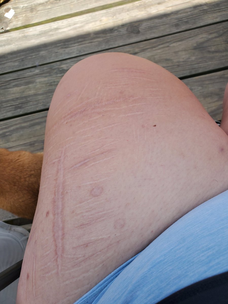 voided_mind's tweet photo. This shit looks crazy healed, tw sh scars https://t.co/lQVXfyx8NU