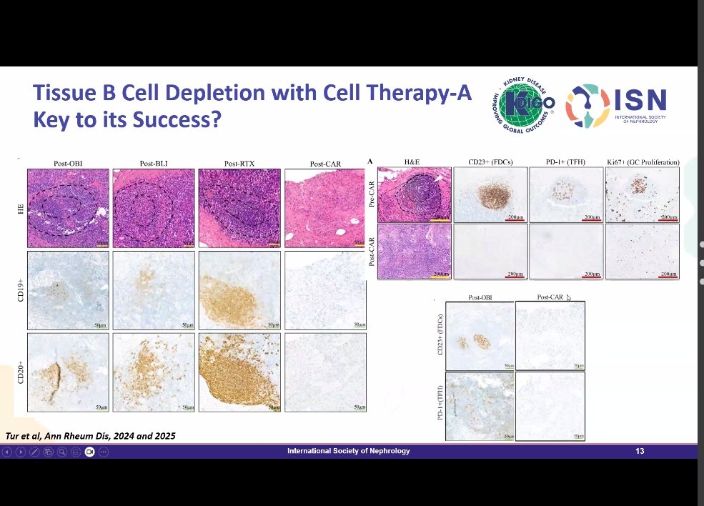 Sandyrvsdav's tweet photo. @ISNeducation @ISNkidneycare @KajareeG @krithicism @myadla @BradRovin CD19 CAR-T may represent the ultimate form of B-cell depletion

Showed success in early studies of refractory SLE/LN

Eliminating not just peripheral B cells but also tissue-resident B cells and germinal centers may be the 🔑 https://t.co/rutJwJoIHt