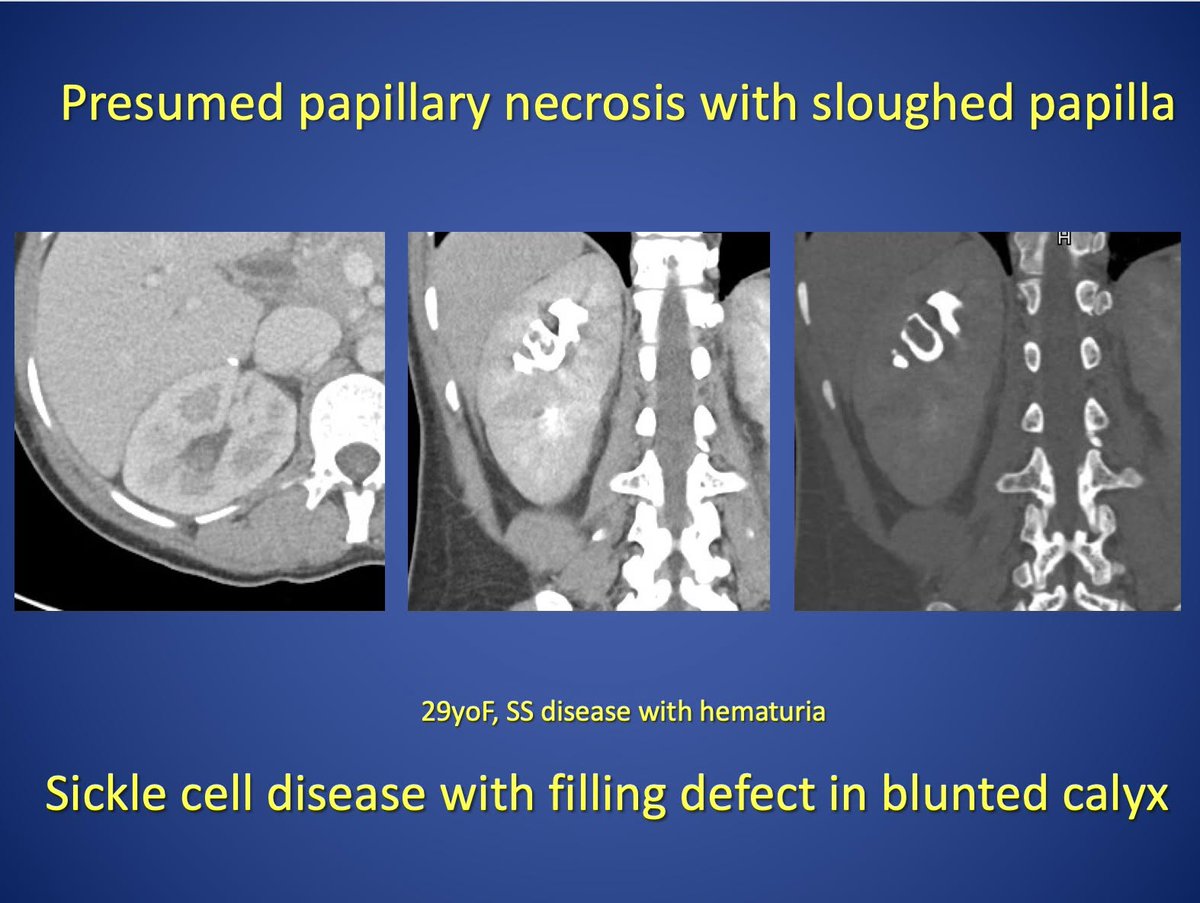 ctisus's tweet photo. Renal Papillary Necrosis https://t.co/Uth6mucC6s