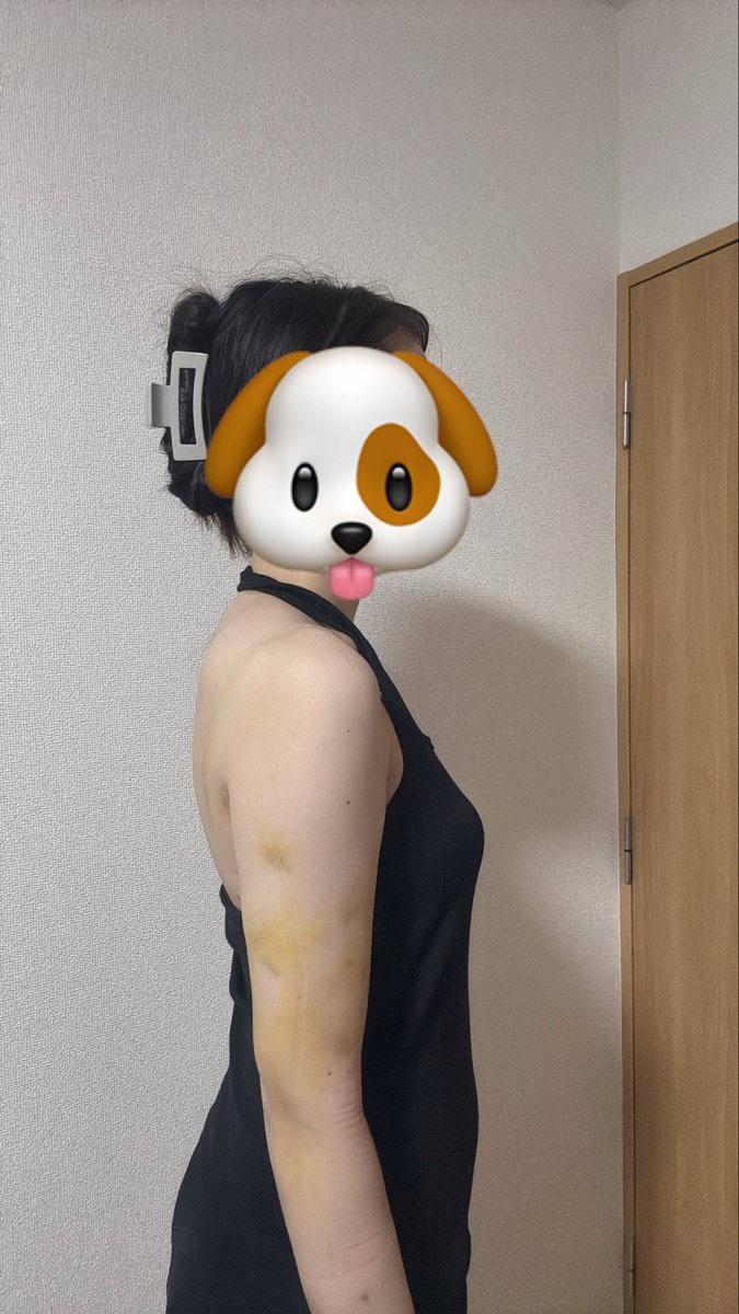 diet_sk98's tweet photo. 二の腕の脂肪吸引して1週間経った〜！！
今日抜糸してもらった！
圧迫外せるようになったけどまだ浮腫みあるから続けようかなぁ🌀
マッサージとストレッチ頑張る💪 https://t.co/QMWj62t8dp