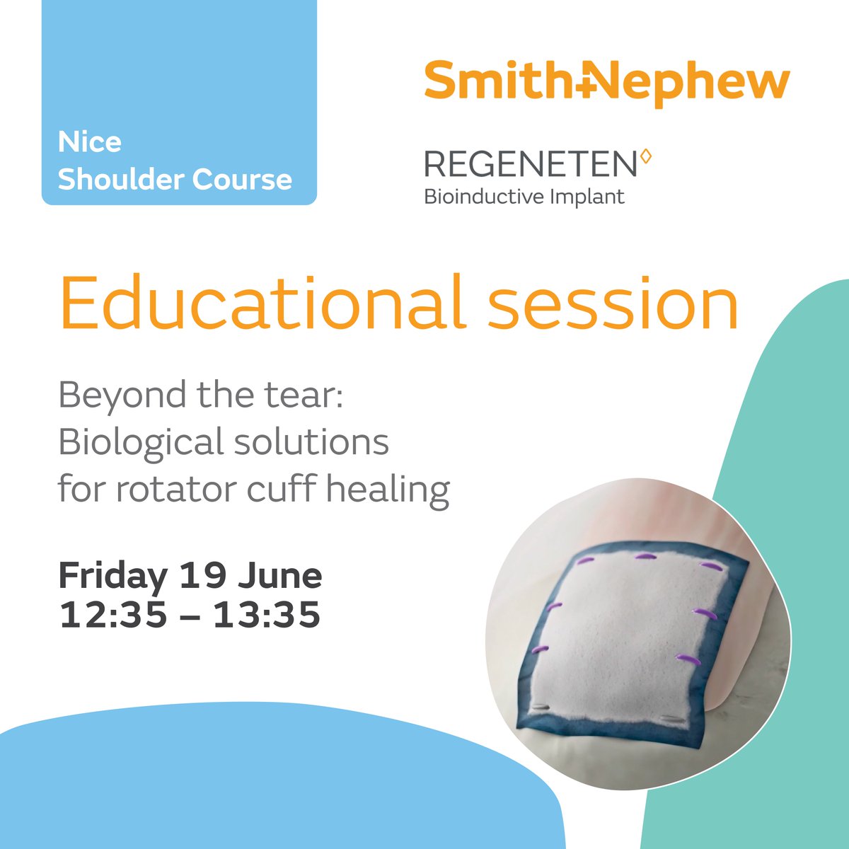 smithnephew's tweet photo. Heading to #NiceShoulder26?Don't miss this expert rotator cuff discussion, case review and Q&amp;A on June 19,with:
✔️Three RCTs showcasing the impact of using the REGENETEN Implant.
✔️AAOS rotator cuff guidelines supporting bioinductive implants.
Latest news: https://t.co/3DZjJdl78j https://t.co/NcHYSjvIV1