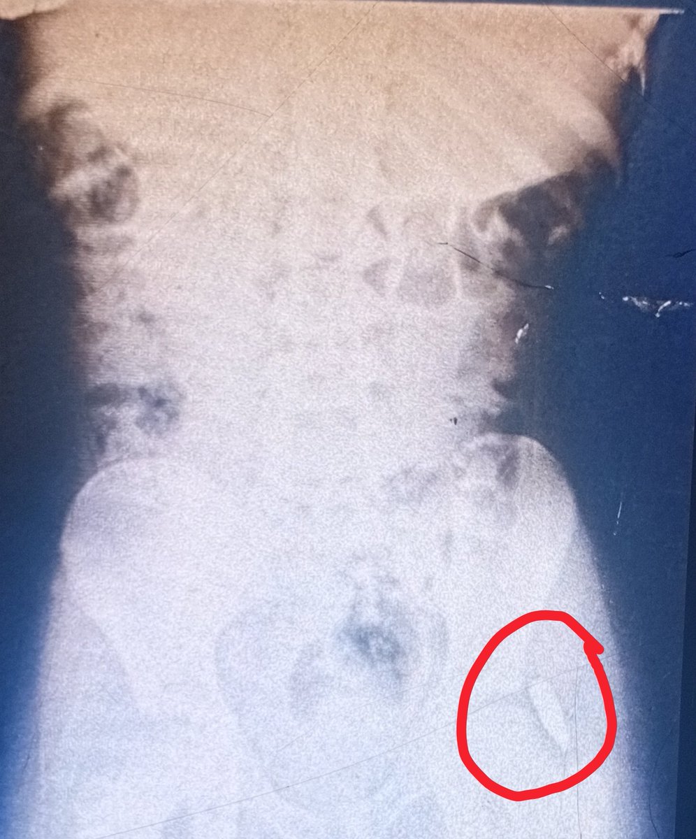 abw27916's tweet photo. O Merciful World we need your support and prayers for my sister.She is currently in the hospital.Tomorrow she will undergo surgery to clean the wound,And also if they can extract the bullet,they will,but the location is very dangerous,close to a nerve.
https://t.co/vNDTy7rj1z https://t.co/7vbn0bsCur