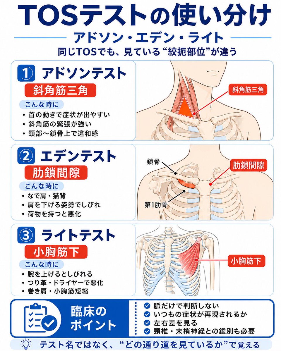jusei_hyoka's tweet photo. 【TOSの検査、全部同じにしてませんか？】

アドソンテスト
エデンテスト
ライトテスト
全部「胸郭出口症候群のテスト」で覚えていると、臨床ではかなり危ないです。
大事なのは、

「どこで絞扼されている可能性を見るテストなのか？」

です。

ざっくり分けると、

アドソンテスト
→ 斜角筋三角

エデンテスト
→ 肋鎖間隙

ライトテスト
→ 小胸筋下
を疑うためのテスト。

つまり、同じTOSでも見ている“通り道”が違います。
たとえば、

首を反らす・回す動きで症状が出やすい
肩こり、斜角筋の緊張が強い
頸部〜鎖骨上窩まわりで違和感が強い
こういう場合は、まず斜角筋三角を疑ってアドソンテスト。

なで肩・猫背
鎖骨と第1肋骨の間が狭そう
荷物を持つ、肩を下げる姿勢でしびれが出る

こういう場合は、肋鎖間隙を疑ってエデンテスト。

腕を挙げるとしびれる
つり革、ドライヤー、洗濯物干しで症状が出る
小胸筋の短縮、巻き肩が強い

こういう場合は、小胸筋下を疑ってライトテスト。
ここで新人時代にやりがちなのが、
「脈が弱くなったから陽性」
「しびれが出たからTOS」

とすぐ決めつけること。

でも実際は、これだけでは不十分です。
見るべきなのは、
・いつもの症状が再現されたか
・左右差があるか
・どの肢位で強くなるか
・頸椎由来、末梢神経障害と区別できているか
・姿勢や肩甲帯の位置とつながるか

です。

整形外科テストは、
「陽性・陰性を決める儀式」ではありません。
どの組織に負荷をかけた時に、
どんな症状が、
どの場所に、
どの程度再現されるのか。
それを整理するための“臨床の質問”です。

TOSを疑うなら、

アドソン＝斜角筋三角
エデン＝肋鎖間隙
ライト＝小胸筋下

この3つをセットで見てください。
検査名を覚えるより、
「どの通路を狭くしているのか？」で覚える。

これだけで、評価の精度はかなり変わります。

#柔道整復師　#若手柔整師　#整形外科テスト　#胸郭出口症候群　#TOS　#アドソンテスト　#エデンテスト　#ライトテスト　#評価ができる柔整師へ