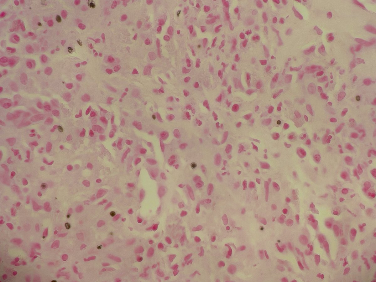 fetot's tweet photo. Monday, monday! Bladder biopsy with malakoplakia - the pathognomonic finding of MG (Michaelis Gutman) bodies were easily found on H&amp;E and confirmed by the von kossa stain. https://t.co/wdMD869jpC