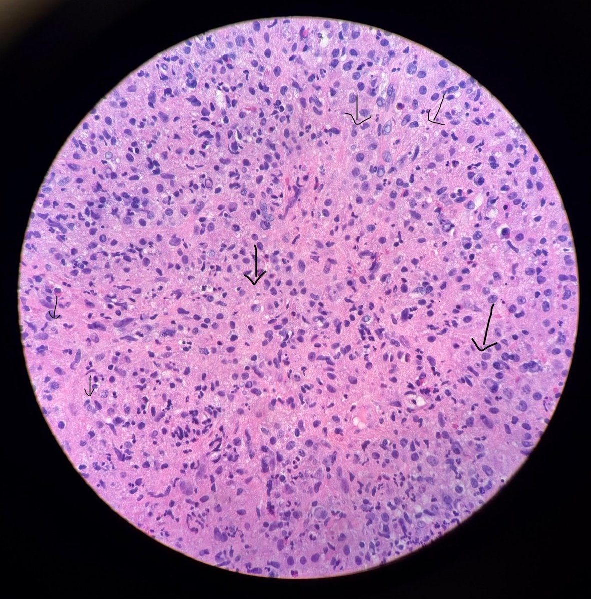 fetot's tweet photo. Monday, monday! Bladder biopsy with malakoplakia - the pathognomonic finding of MG (Michaelis Gutman) bodies were easily found on H&amp;E and confirmed by the von kossa stain. https://t.co/wdMD869jpC